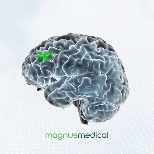 3D brain illustration with a small frontal region highlighted in green